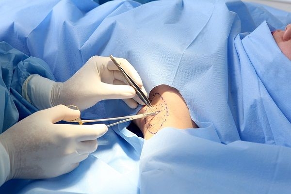 Phẫu thuật thường được ít sử dụng ở nước ngoài do rủi ro khi cắt mổ là khá cao.