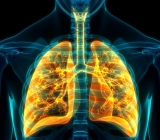 Công nghệ tế bào gốc trong điều trị ung thư phổi
