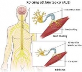 Điều trị Bệnh xơ cứng teo cơ bên (ALS) bằng công nghệ tế bào gốc nội sinh