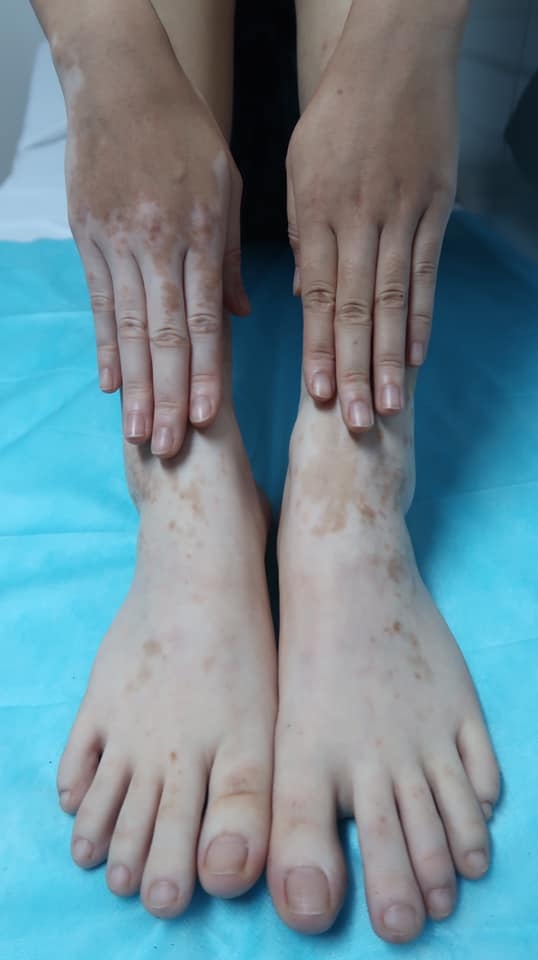 Chứng bạch biến - Hiểm họa không ngờ từ Lá trầu không khi dùng chữa ra mồ hôi tay chân