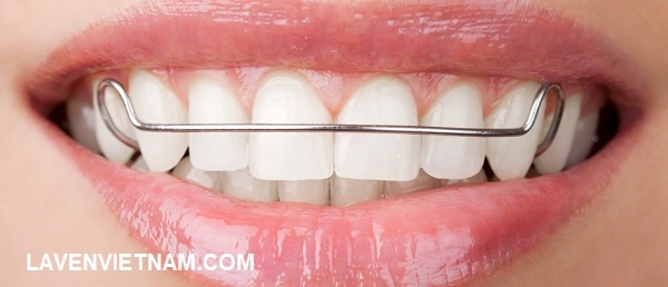 Đeo hàm duy trì sau khi hoàn tất niềng răng