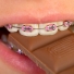 Có nên ăn đồ ngọt và kẹo khi niềng răng