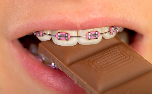 Cẩn trọng khi ăn socola để bảo vệ răng niềng của bạn